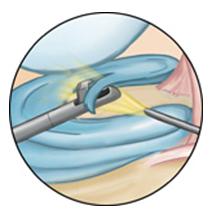 Close-up of meniscal repair