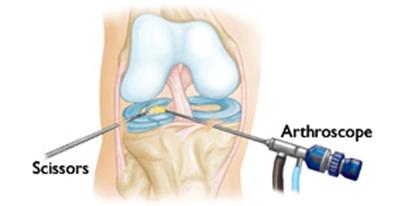 Knee arthroscopy