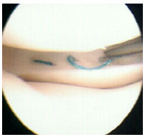 meniscus repair